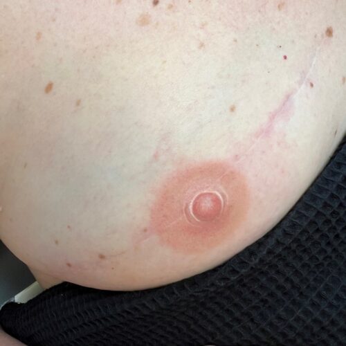 Areola Restoration Tattoo Vancouver DAELA Lina
