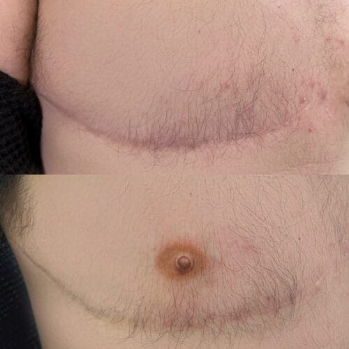 Areola Restoration in Portland at DAELA by Lina