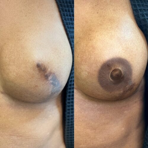 Areola Restoration in Portland at DAELA by Lina