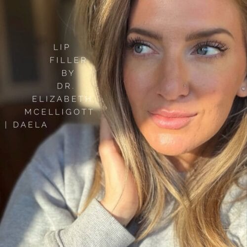 Lip Filler by Dr Elizabeth McElligot