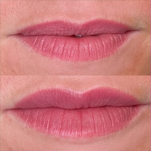 Lip Filler Portland DAELA