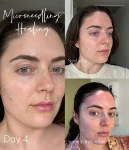 microneedling in scottsdale at daela