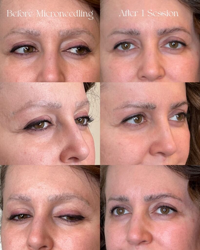 Microneedling for Brow hair Growth