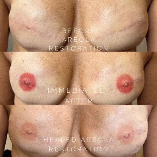 Areola Restoration Tattoo in Scottsdale by Katy