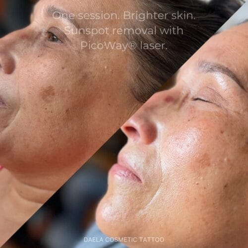 Laser facials in Scottsdale at DAELA