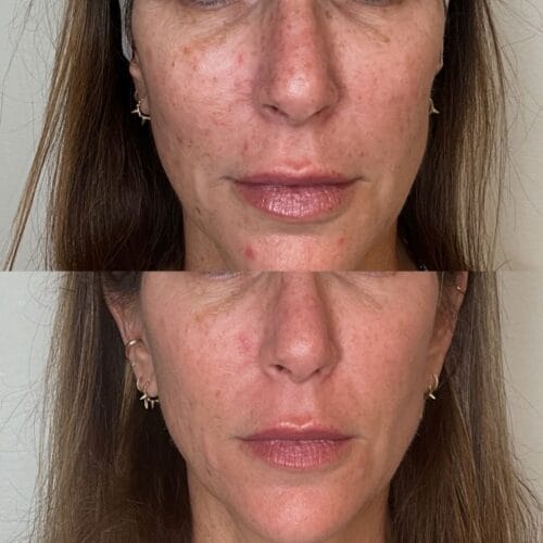 Laser Skin Treatment at DAELA Portland by Bella