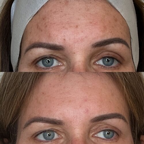 Laser Skin Treatment at DAELA Portland by Bella