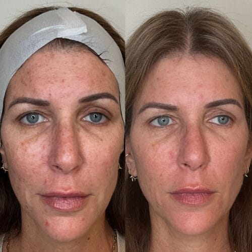 Laser Skin Treatment at DAELA Portland by Bella