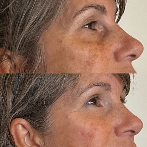 Laser Skin Treatment at DAELA Portland by Bella