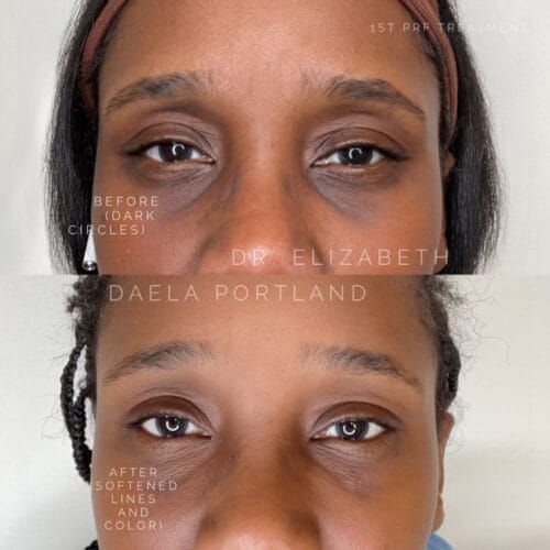 PRF for Undereye at DAELA Portland by Dr. Elizabeth McElligott