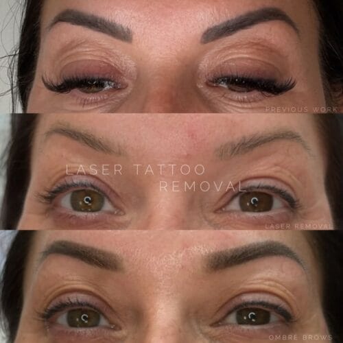 Cosmetic Laser Tattoo Removal at DAELA Portland by Bella