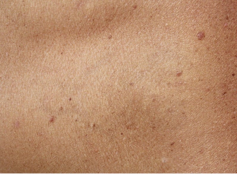 laser tattoo removal in Portland Oregon