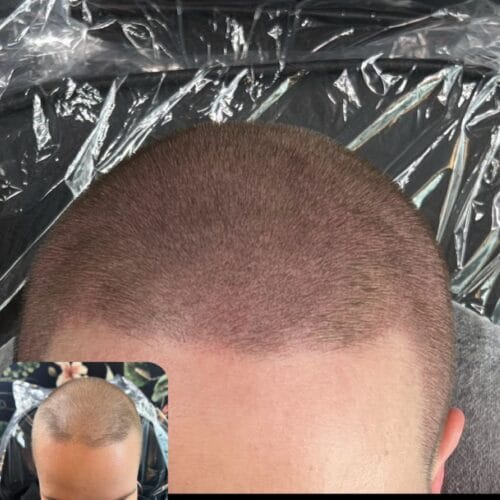 Scalp Micropigmentation Density for Women at DAELA Cosmetic Tattoo