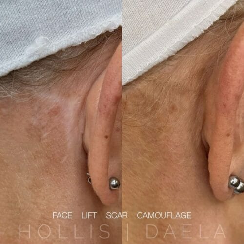Camouflage Facelift Scarring at DAELA Scottsdale