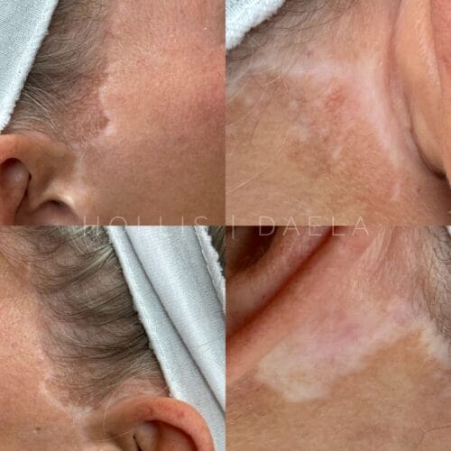 Camouflage Facelift Scarring at DAELA Scottsdale