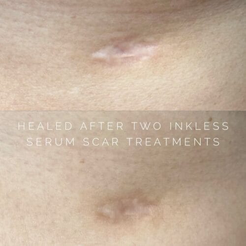 Scar Camouflage Tattoo in Scottsdale at DAELA