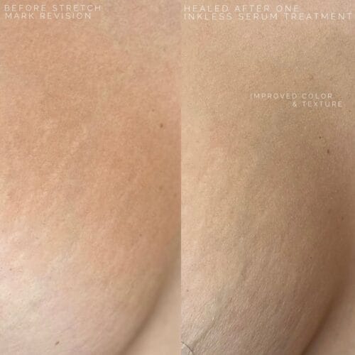 stretch mark camouflage in Scottsdale at DAELA