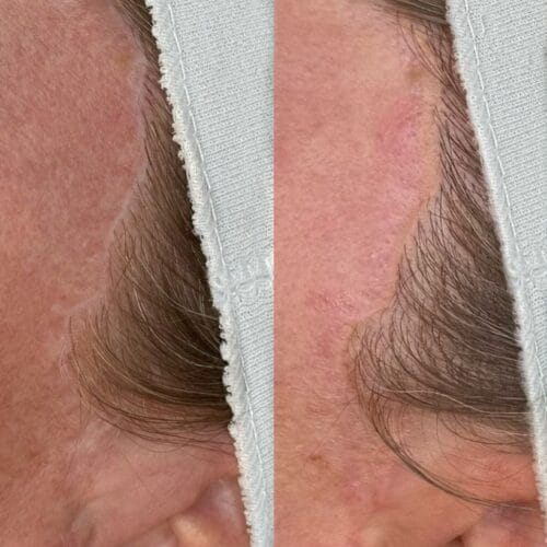 Camouflage Facelift Scarring at DAELA Scottsdale