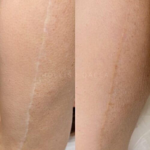 Scar Camouflage Tattoo in Scottsdale at DAELA