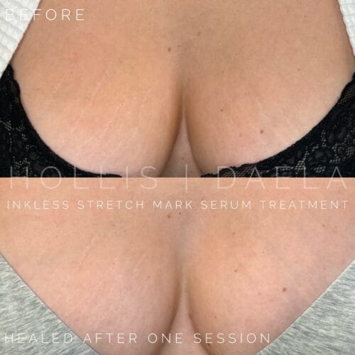 stretch mark camouflage in Scottsdale at DAELA