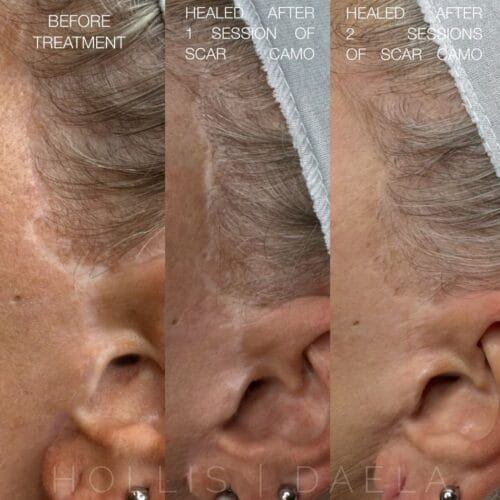 Scar Camouflage in Scottsdale AZ