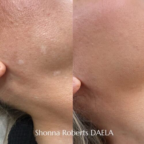 Scar Camouflage in Portland at DAELA by Shonna