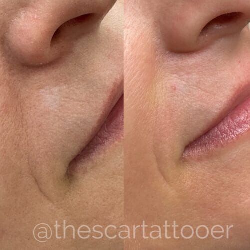 Scar Camouflage Tattoo DAELA Cosmetic Tattoo Portland-Shonna