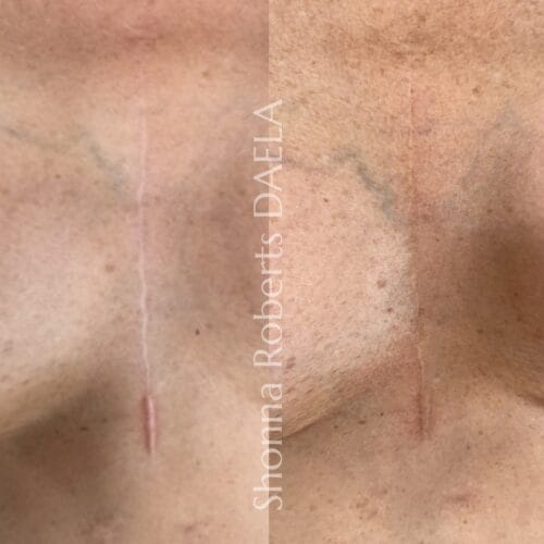 Scar Camouflage in Portland at DAELA by Shonna