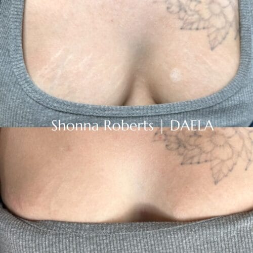 Scar Camouflage Tattoo by Shonna at DAELA Cosmetic Tattoo
