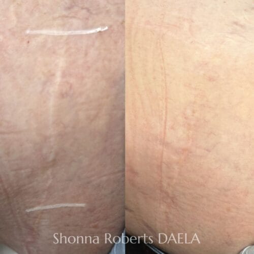 Scar Camouflage Tattoo by Shonna at DAELA Cosmetic Tattoo