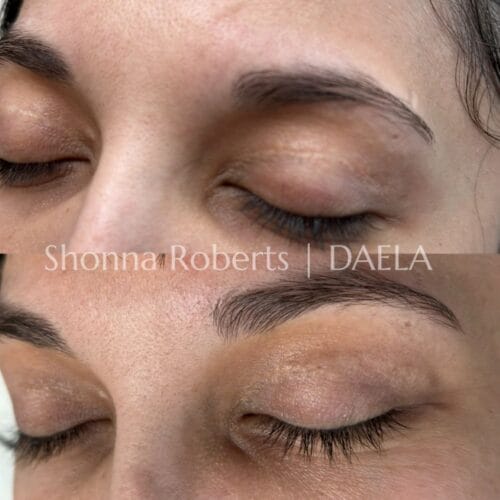 Scar Camouflage Tattoo by Shonna at DAELA Cosmetic Tattoo