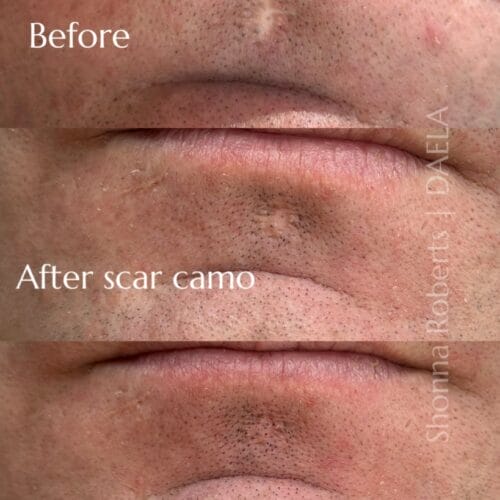 Scar Camouflage Tattoo by Shonna at DAELA Cosmetic Tattoo