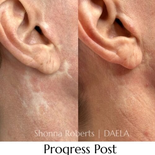 Scar Camouflage Tattoo by Shonna at DAELA Cosmetic Tattoo