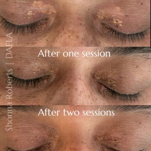 Scar Camouflage Tattoo by Shonna at DAELA Cosmetic Tattoo