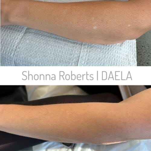 Scar Camouflage Tattoo by Shonna at DAELA Cosmetic Tattoo