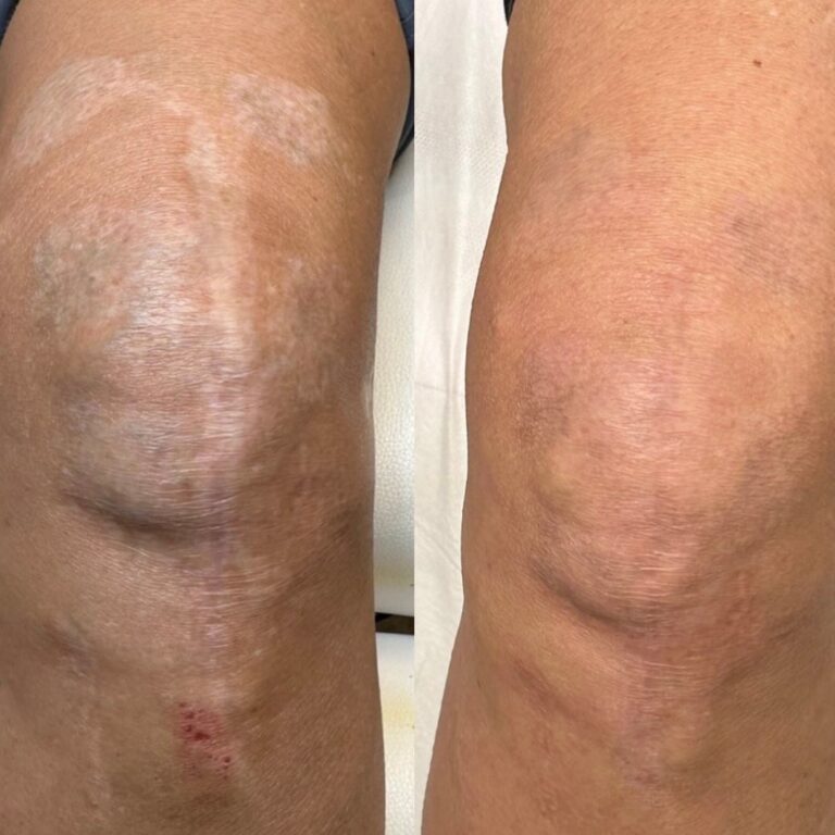 Scar Camouflage Tattoo DAELA Vancouver