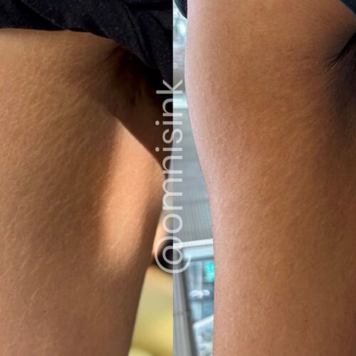 Stretch Mark Treatments Vancouver DAELA Shonna