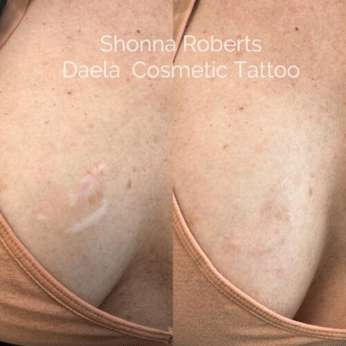 Scar Camouflage Tattoo by Shonna at DAELA Cosmetic Tattoo