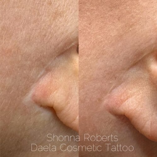 Scar Camouflage Tattoo by Shonna at DAELA Cosmetic Tattoo
