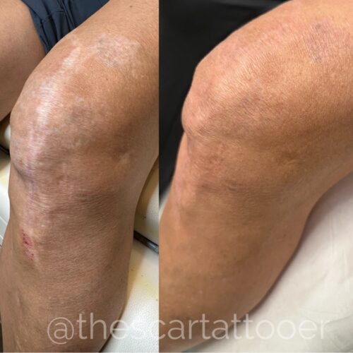 Scar Camouflage Tattoo Vancouver DAELA Shonna