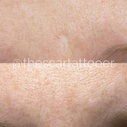 Scar Camouflage Tattoo Vancouver DAELA Shonna