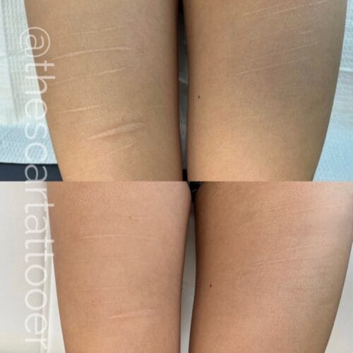 Scar Camouflage Portland DAELA Shonna