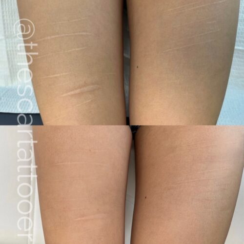 Scar Camouflage Tattoo Vancouver DAELA Shonna