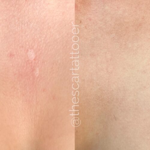 Scar Camouflage Tattoo Vancouver DAELA Shonna