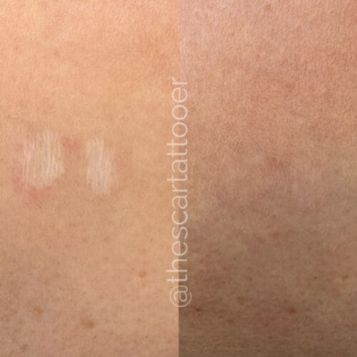 Scar Camouflage Portland DAELA Shonna