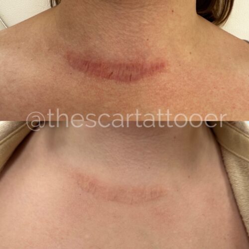 Scar Camouflage Tattoo Vancouver DAELA Shonna