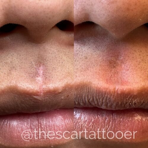 Scar camouflage tattoo by Shonna at DAELA Cosmetic Tattoo