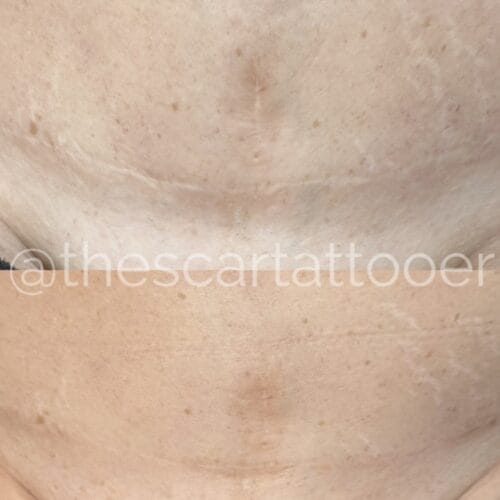 Scar camouflage tattoo by Shonna at DAELA Cosmetic Tattoo