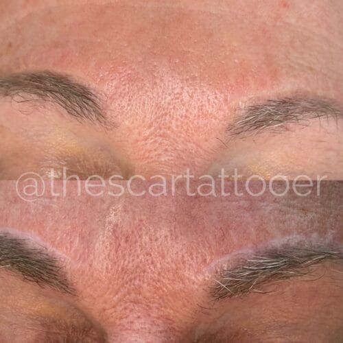 Scar camouflage tattoo by Shonna at DAELA Cosmetic Tattoo