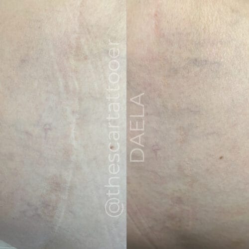 Scar Camouflage Tattoo in Portland at DAELA by Shonna